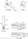 Fig. 74 - Methods and devices for intracorporeal bonding of implants with thermal energy