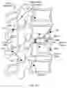 Fig. 78 - Methods and devices for intracorporeal bonding of implants with thermal energy