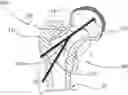 Fig. 01 - DEVICES, METHODS AND SYSTEMS FOR REMEDYING OR PREVENTING FRACTURES