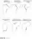 Fig. 03 - DEVICES, METHODS AND SYSTEMS FOR REMEDYING OR PREVENTING FRACTURES
