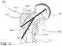 Fig. 04 - DEVICES, METHODS AND SYSTEMS FOR REMEDYING OR PREVENTING FRACTURES