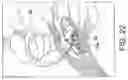 Fig. 18 - Tibial plateau leveling osteotomy plate