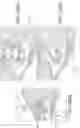 Fig. 24 - Tibial plateau leveling osteotomy plate