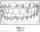 Fig. 02 - Maxillomandibular fixation device