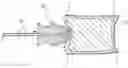 Fig. 01 - Systems, methods, and apparatus for spinal deformity correction