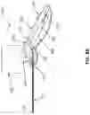 Fig. 11 - TISSUE VISUALIZATION AND MODIFICATION DEVICES AND METHODS