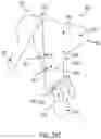 Fig. 141 - METHOD FOR TISSUE TREATMENT BY SURGICAL INSTRUMENT