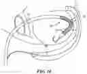 Fig. 07 - INTRACARDIAC TOOLS AND METHODS FOR DELIVERY OF ELECTROPORATION THERAPIES
