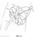 Fig. 09 - INTRACARDIAC TOOLS AND METHODS FOR DELIVERY OF ELECTROPORATION THERAPIES