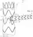 Fig. 06 - Stent graft with fenestration lock and methods of use