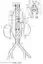 Fig. 08 - Stent graft with fenestration lock and methods of use