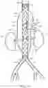 Fig. 09 - Stent graft with fenestration lock and methods of use