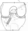 Fig. 01 - Dynamic ligament repair device