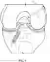 Fig. 02 - Dynamic ligament repair device