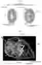 Fig. 11 - TOOL FOR TRICUSPID REGURGITATION OPERATION