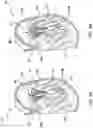 Fig. 03 - Prolapse prevention device and methods of use thereof