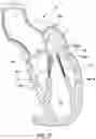 Fig. 14 - Prolapse prevention device and methods of use thereof