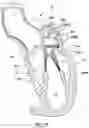 Fig. 16 - Prolapse prevention device and methods of use thereof