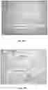 Fig. 30 - Bioabsorbable textiles and methods for joint function restoration
