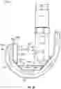 Fig. 04 - KNEE REPLACEMENT IMPLANT HAVING STACKABLE SPACERS