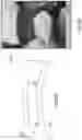 Fig. 48 - Artificial spinal prosthesis and method