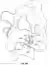 Fig. 74 - Artificial spinal prosthesis and method
