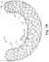Fig. 03 - Balloon expandable endoprosthesis