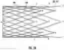 Fig. 14 - Expandable sheath