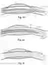 Fig. 05 - DEVICE FOR THE TREATMENT OF A MYOCARDIAL INFARCTION
