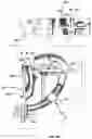 Fig. 22 - TOOLS AND METHODS FOR DACRYOCYSTORHINOSTOMY