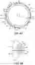 Fig. 05 - Intraocular implants and related kits and methods