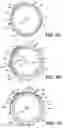 Fig. 06 - Intraocular implants and related kits and methods