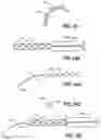 Fig. 44 - Intraocular implants and related kits and methods