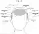 Fig. 11 - SUBCUTANEOUS TISSUE THERAPY TREATMENT METHOD