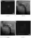 Fig. 02 - Methods of treating disorders associated with glycosylation defective proteins