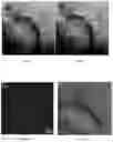 Fig. 03 - Methods of treating disorders associated with glycosylation defective proteins
