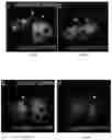 Fig. 07 - Methods of treating disorders associated with glycosylation defective proteins
