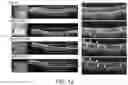 Fig. 11 - METHODS FOR MEASURING THERAPEUTIC EFFECTS OF RETINAL DISEASE THERAPIES