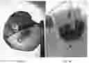 Fig. 02 - TISSUE SPACERS