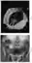 Fig. 12 - TISSUE SPACERS