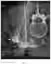 Fig. 13 - TISSUE SPACERS