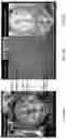 Fig. 15 - TISSUE SPACERS