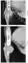 Fig. 16 - TISSUE SPACERS