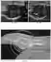Fig. 17 - TISSUE SPACERS