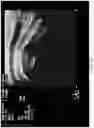Fig. 11 - Occlusive implant compositions
