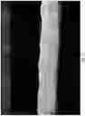 Fig. 13 - Occlusive implant compositions