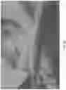 Fig. 22 - Occlusive implant compositions