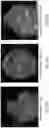 Fig. 41 - Occlusive implant compositions