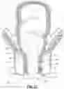 Fig. 12 - OBTURATOR, METHODS OF FORMING A PREFABRICATED, INNERVATED, PRE-VASCULARIZED, PRELAMINATED (PIPP) FLAP USING AN OBTURATOR TO MAINTAIN A STOMA OR LUMEN, AND METHODS OF RESTORING DAMAGED OR SURGICALLY-REMOVED SOFT TISSUE WITH A PIPP FREE OR ROTATIONAL FLAP