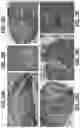 Fig. 14 - OBTURATOR, METHODS OF FORMING A PREFABRICATED, INNERVATED, PRE-VASCULARIZED, PRELAMINATED (PIPP) FLAP USING AN OBTURATOR TO MAINTAIN A STOMA OR LUMEN, AND METHODS OF RESTORING DAMAGED OR SURGICALLY-REMOVED SOFT TISSUE WITH A PIPP FREE OR ROTATIONAL FLAP